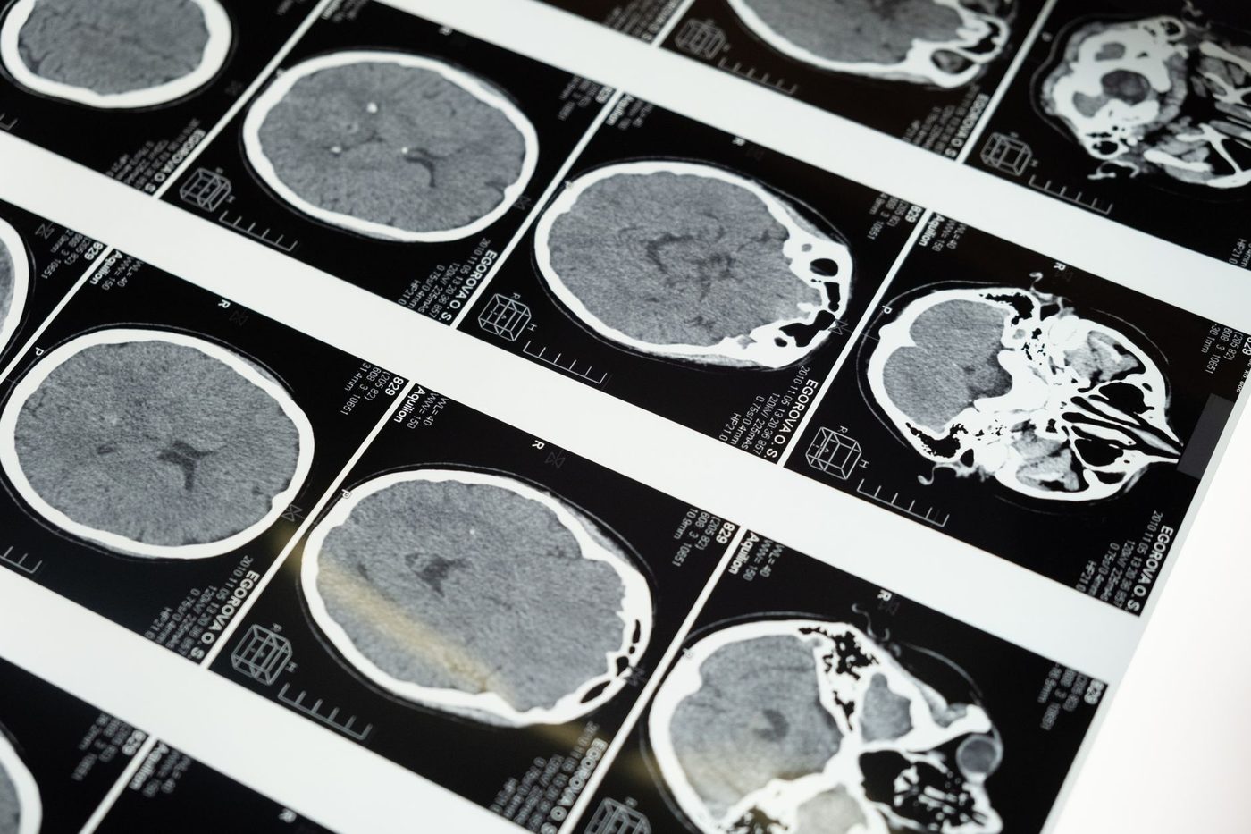Medische AI-modellen herkennen anatomische patronen, maar kunnen niet redeneren over ruimtelijke relaties